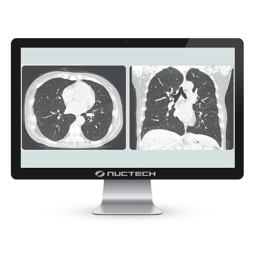 neuviz-ace-up-monitor-pulmones neuviz-ace-up-monitor-pulmones