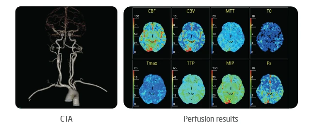neuviz-epoch-64cm-cobertura-perfusion neuviz-epoch-64cm-cobertura-perfusion